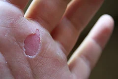 Common site for a rip (along the surface of the palm that bears weight when hanging)