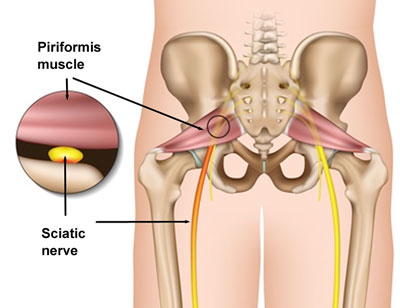 Note the relationship between the piriformis muscle and the sciatic nerve.