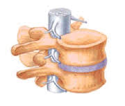 View of a vertebral segment (two vertebrae and the disc between)
