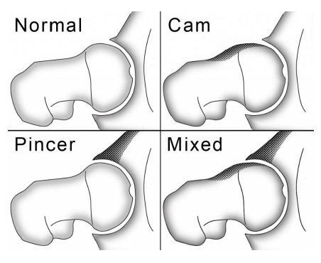 impingemet fai.png