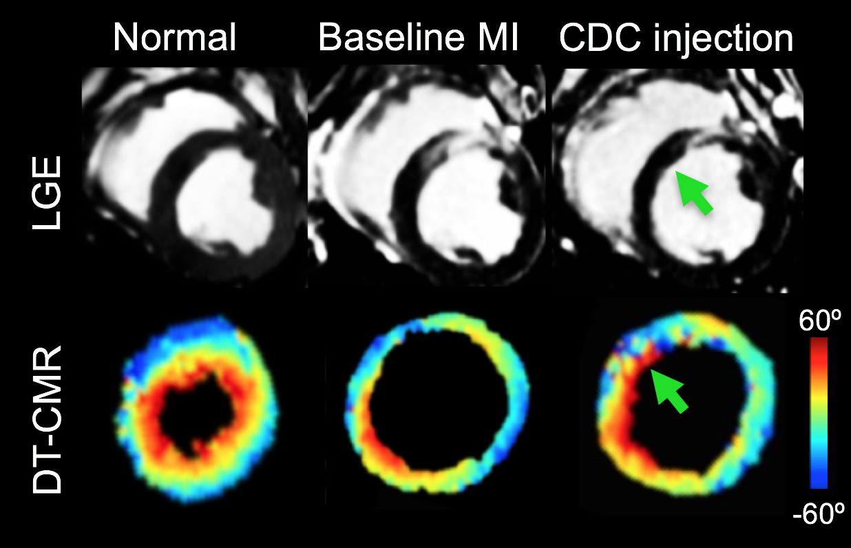 Myocardial Regeneration Therapy Evaluation with DT-CMR