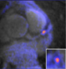 Coronary Atherosclerosis Characterization (CATCH)