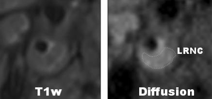 Detecting Lipid Rich Necrotic Core with DW-MRI