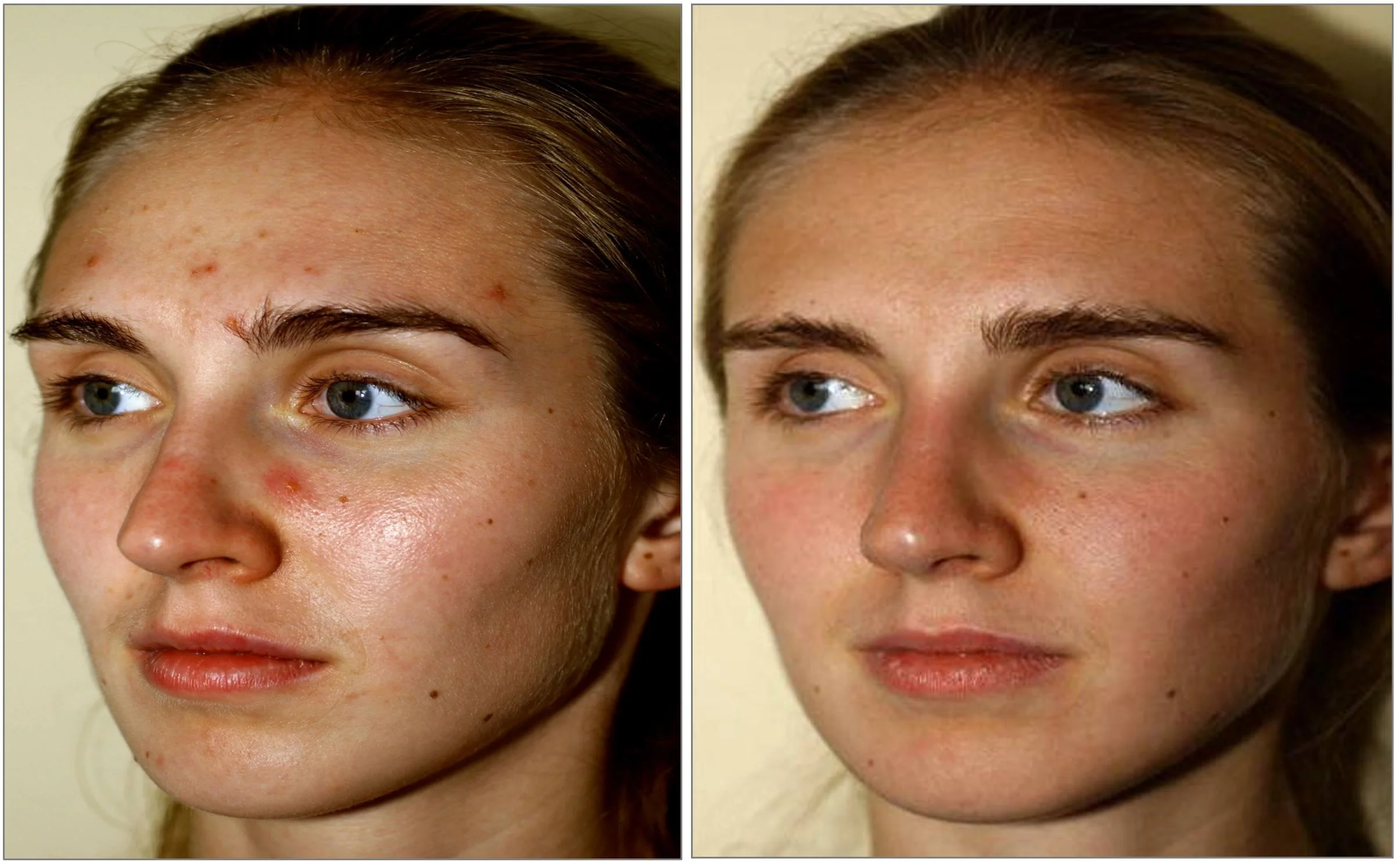 Villani Treatment™