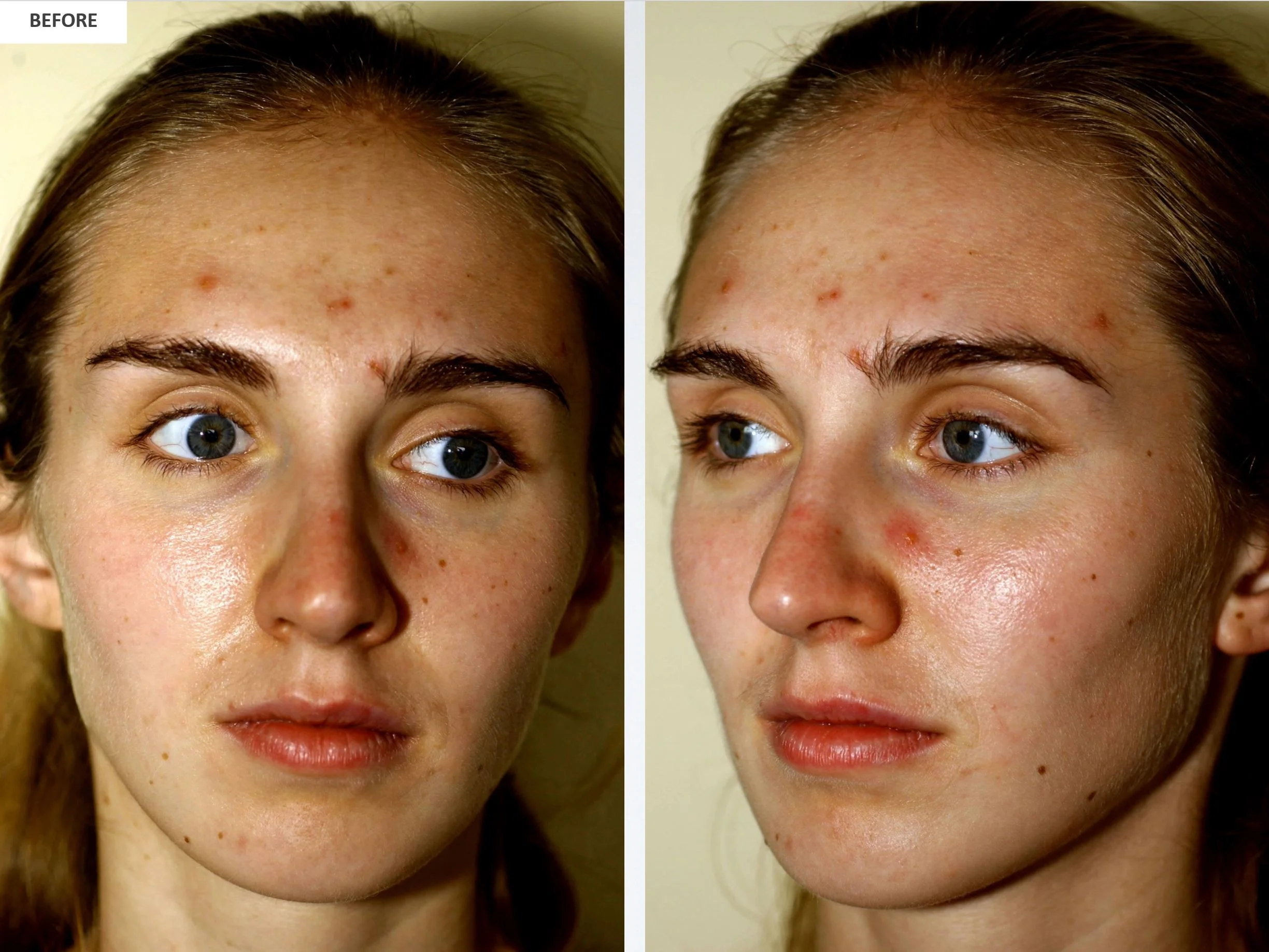 Villani Treatment™