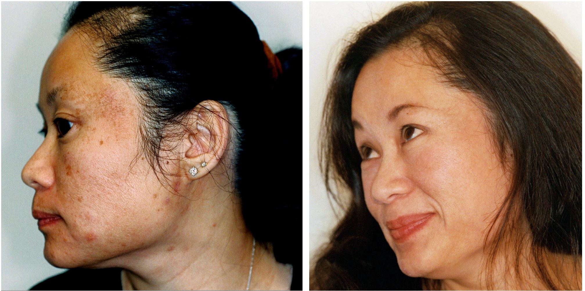 Villani Treatment™