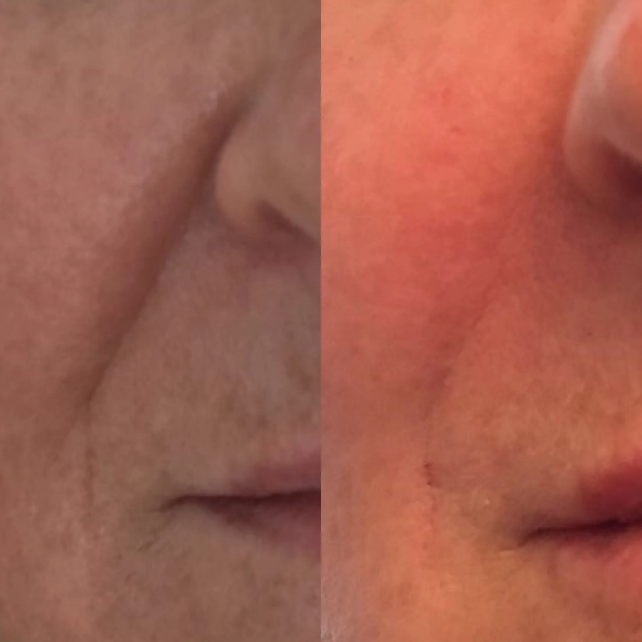 Nasolabial folds treated with Juvederm Ultra. Before and immediately after.