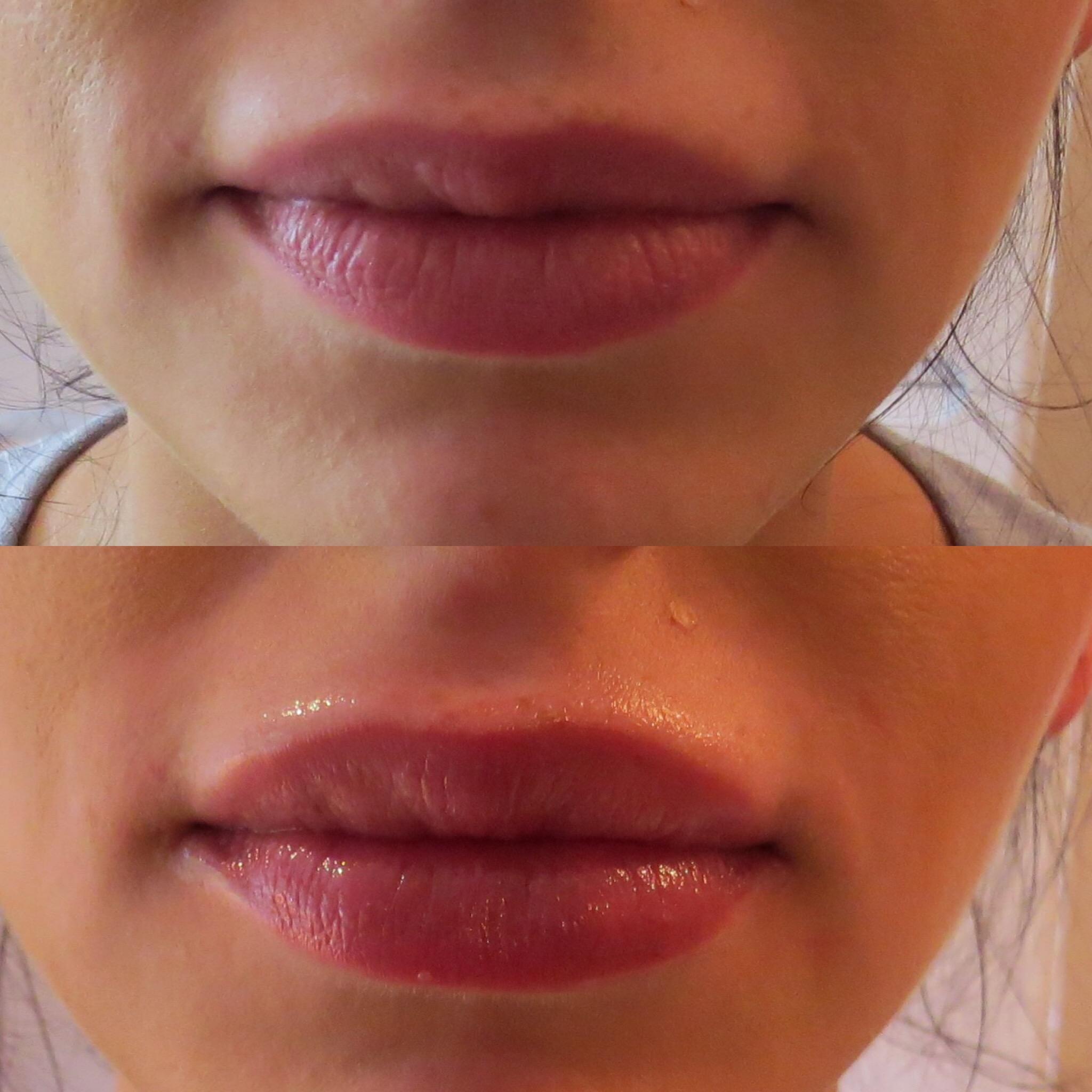 0.5ml Juvederm Smile for additional volume and symmetry