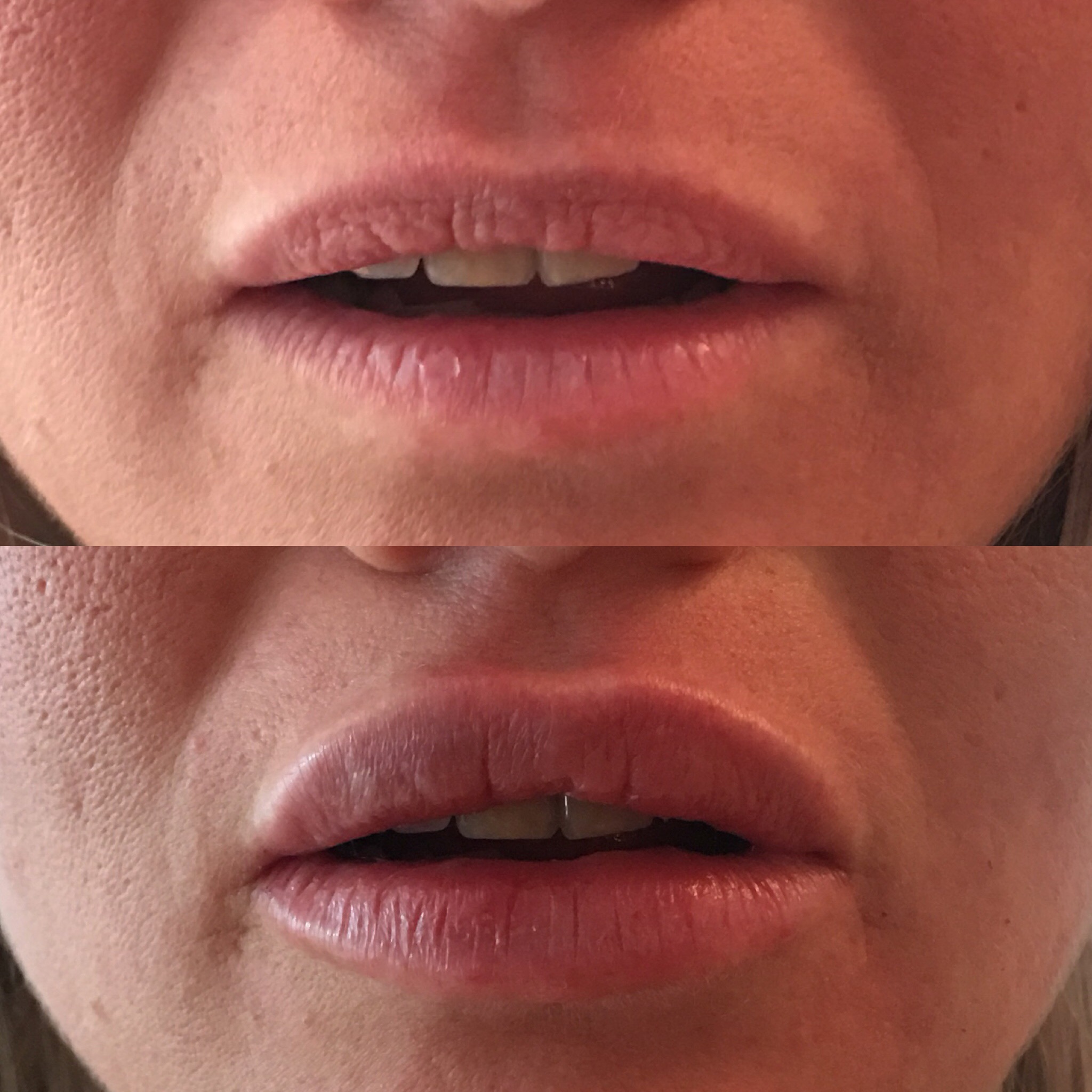 2ml Juvederm