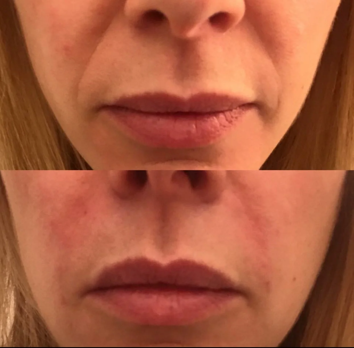 Before and after nasolabial folds 1.5ml Juvederm
