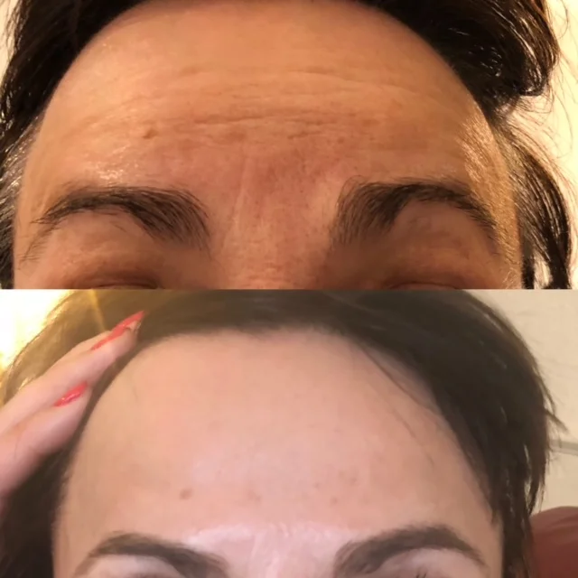 Anti-wrinkle injections- much smoother skin texture and nowrinkles