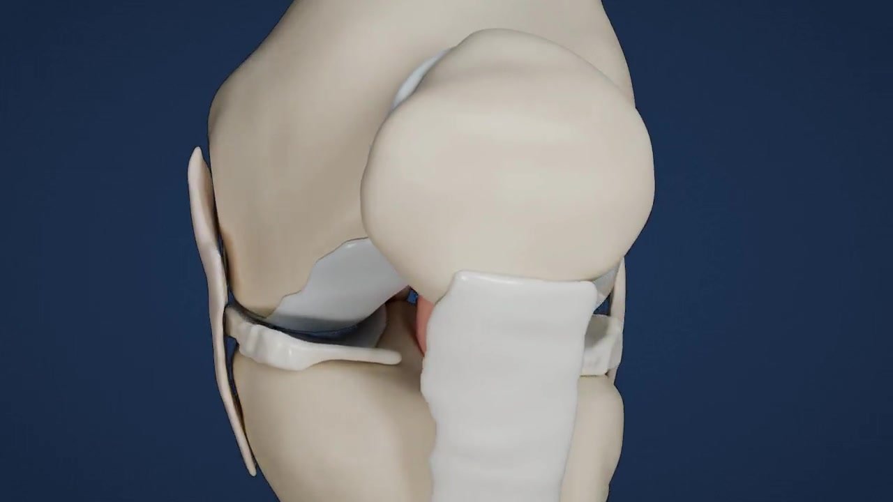 When Can I Drive After ACL Surgery?