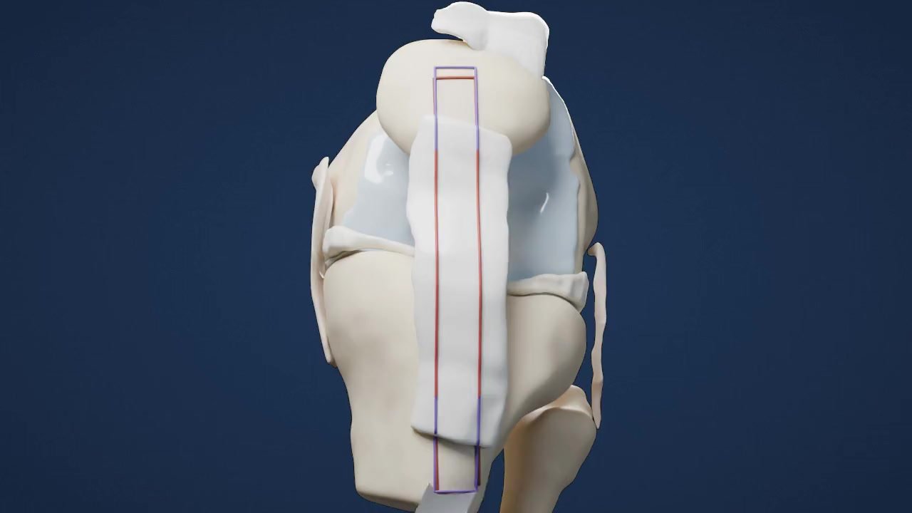 Which ACL Graft Is Best? Patellar Tendon, Quad Tendon, Hamstring, or Donor