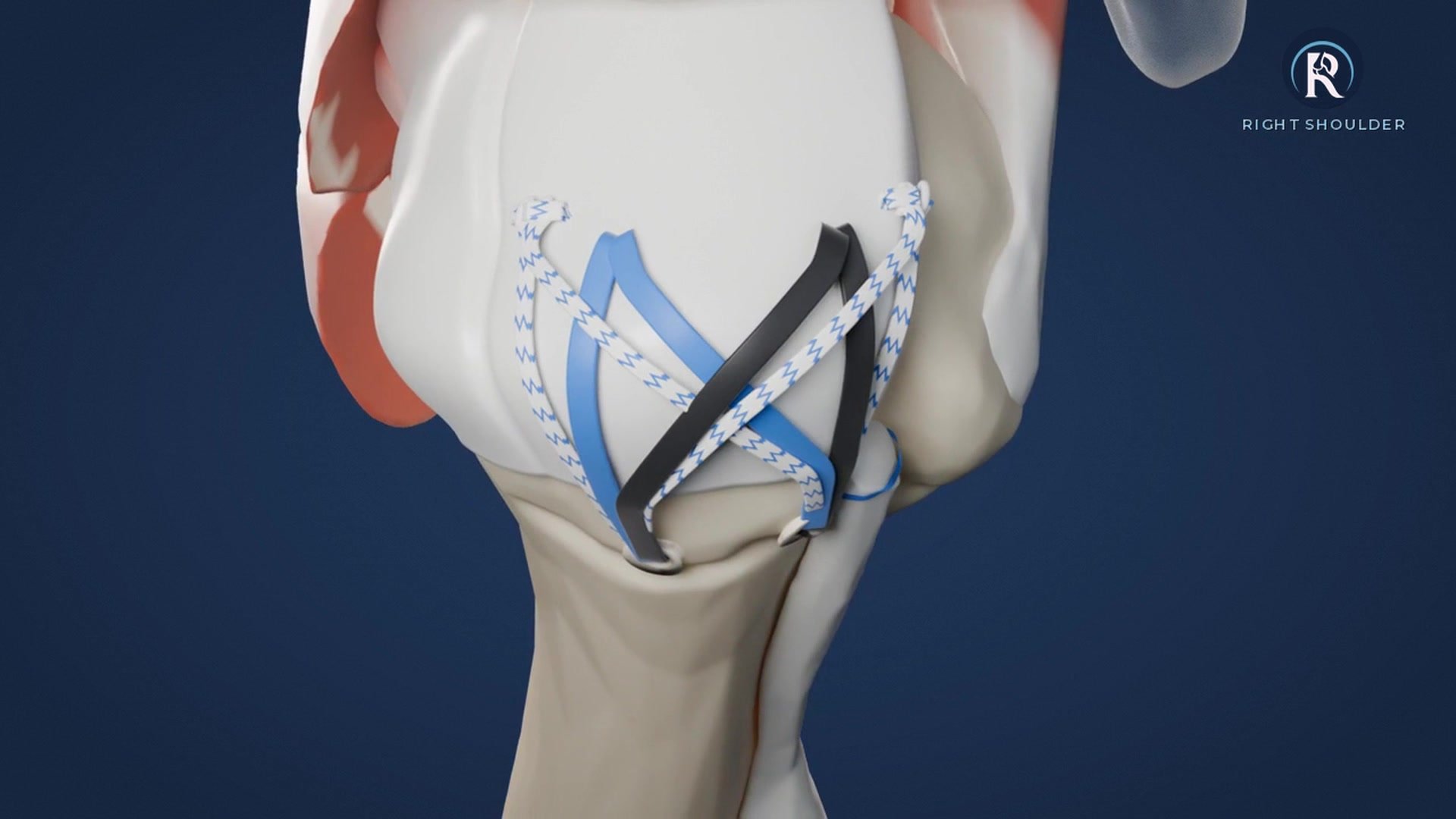 What Happens During Rotator Cuff Repair Surgery: A Step-by-Step Guide