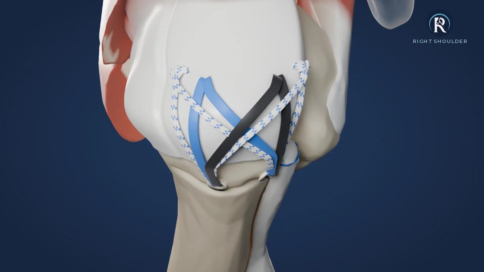 Preparing for Rotator Cuff Repair Surgery: What You Need to Know 