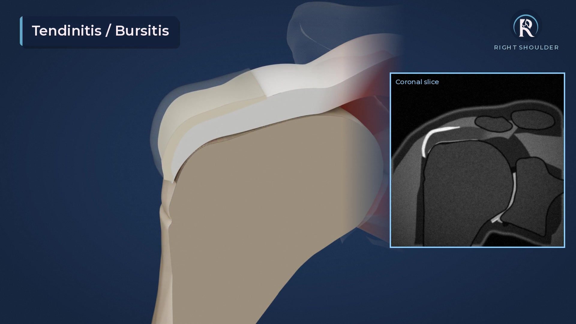 Conservative Treatment Options for Rotator Cuff Tears: Physical Therapy and Medications