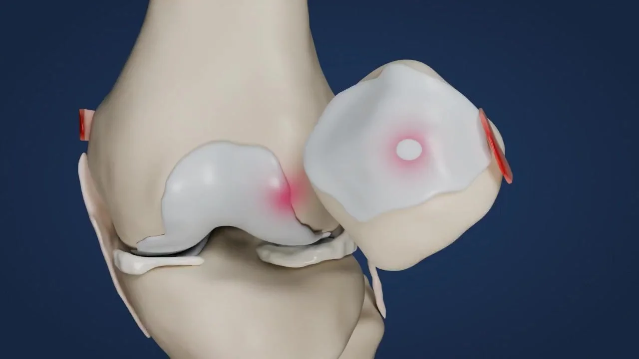 Dislocated Kneecap: Will It Happen Again?