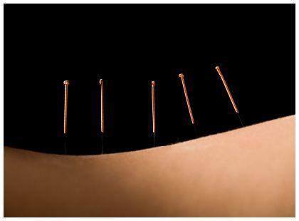 dry-needling-trigger-points.jpg