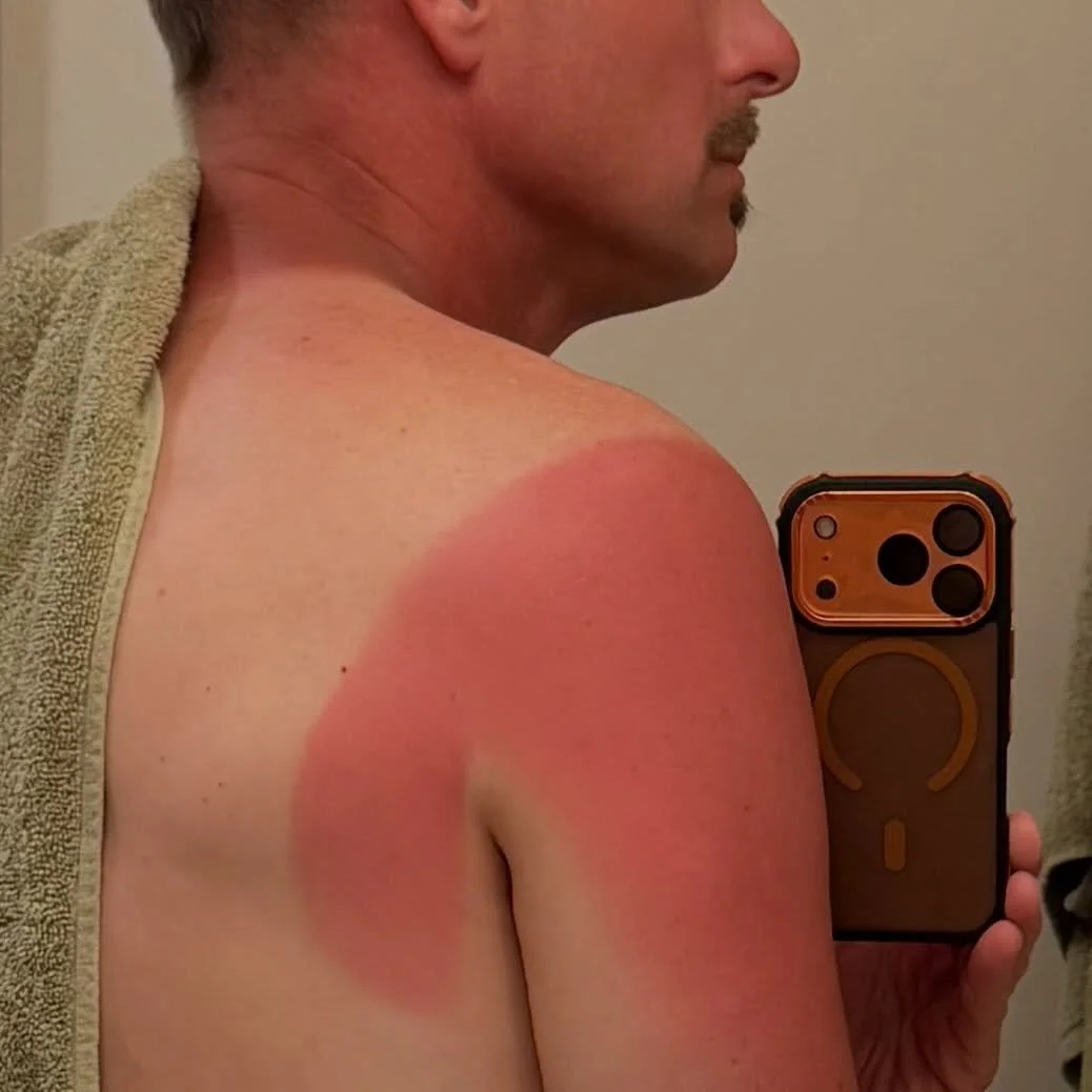 This is what walking 10 miles on the Mississippi River in St James Parish, Louisiana will get you in springtime. I guess I waited a little too long to get out the sunscreen. #thelongwalkusa_bigriver