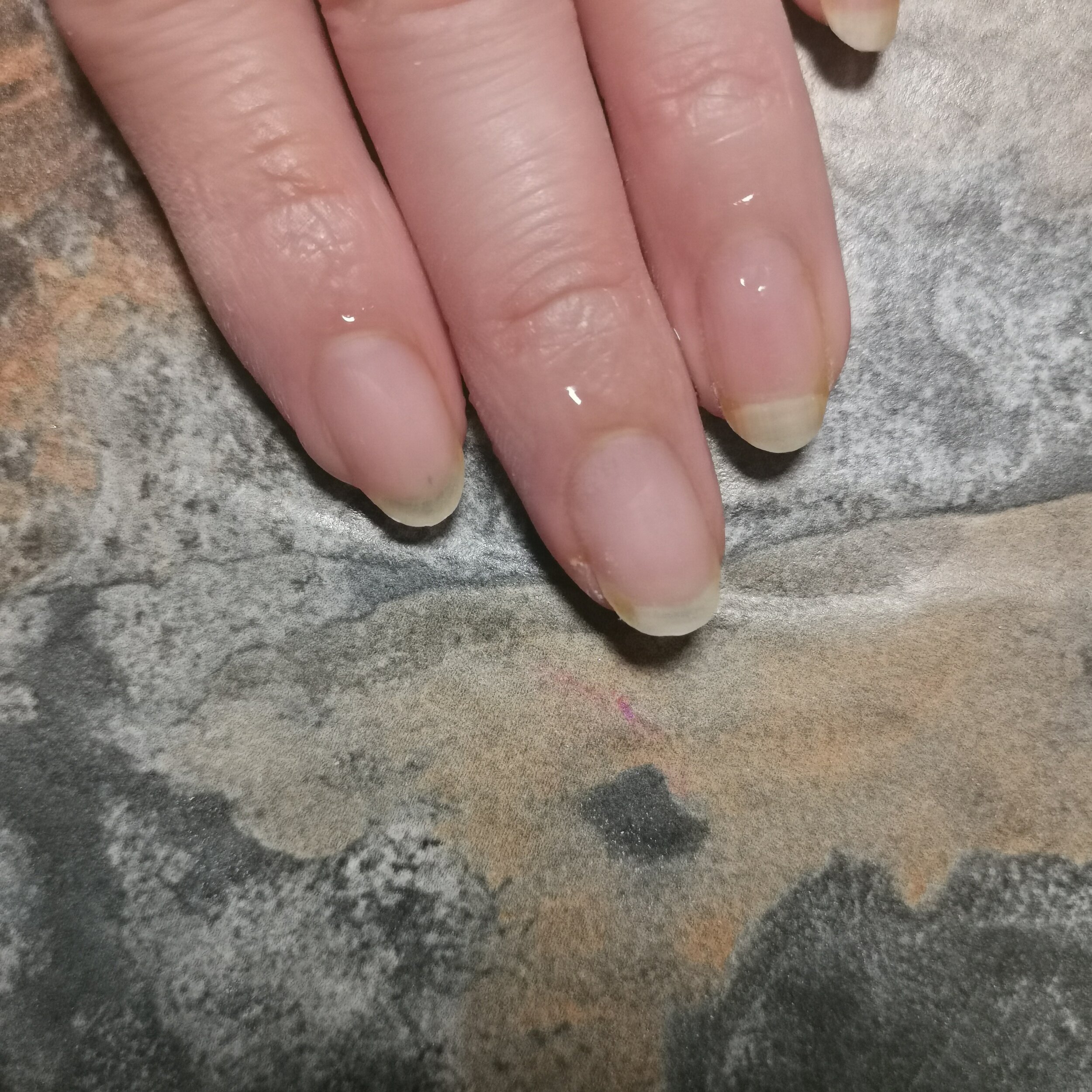 Anyone know what causes this skin peeling around the nail bed? (Excuse red  hands, have raynauds) : r/Nails