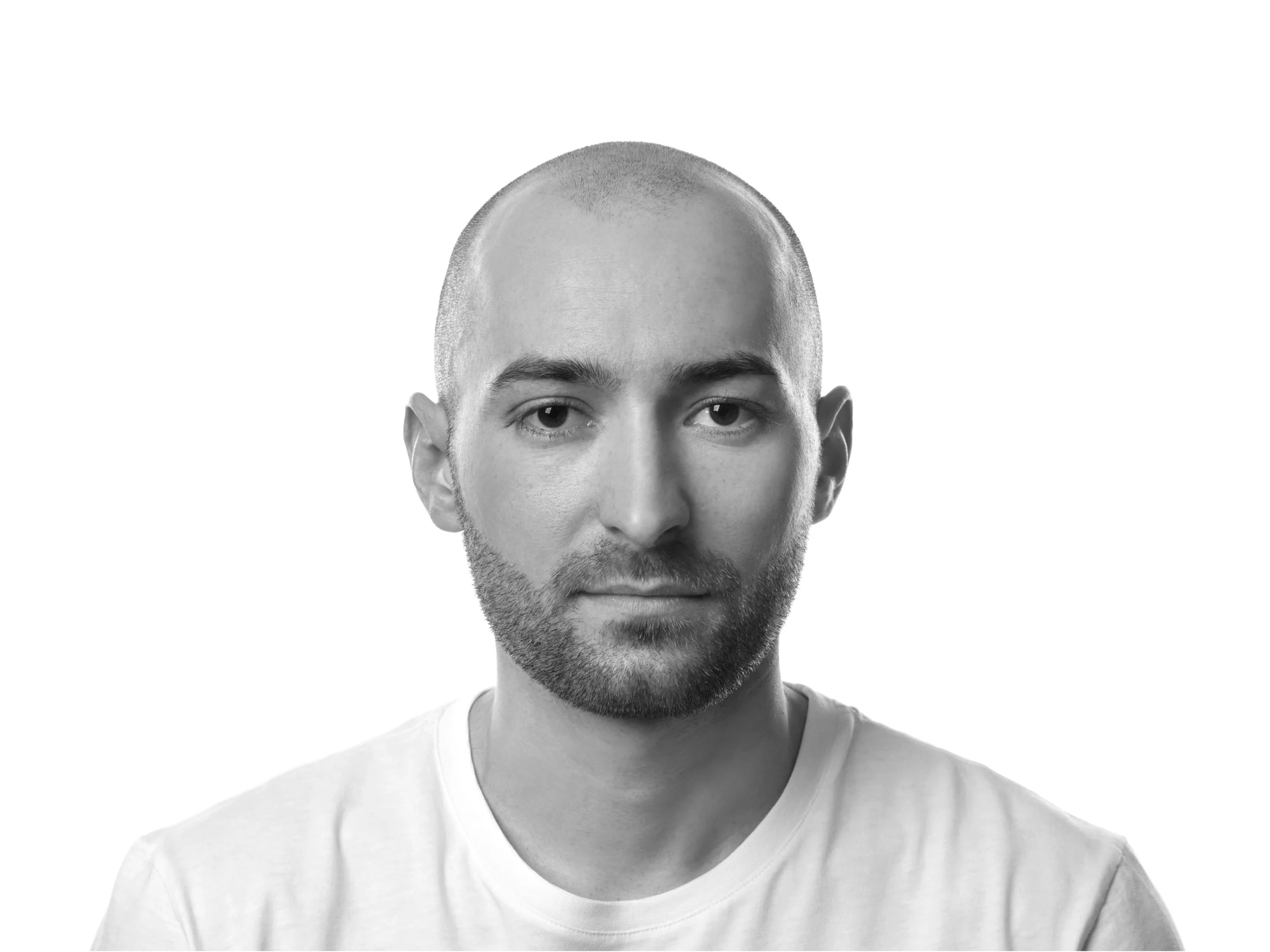 Before Scalp Micropigmentation