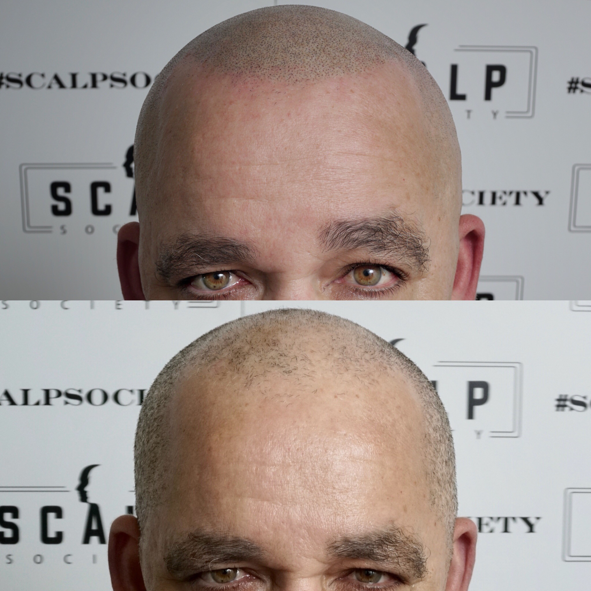 Male 62. Micropigmentation is for all ages. We specialize in making your hairline look as natural as possible. 