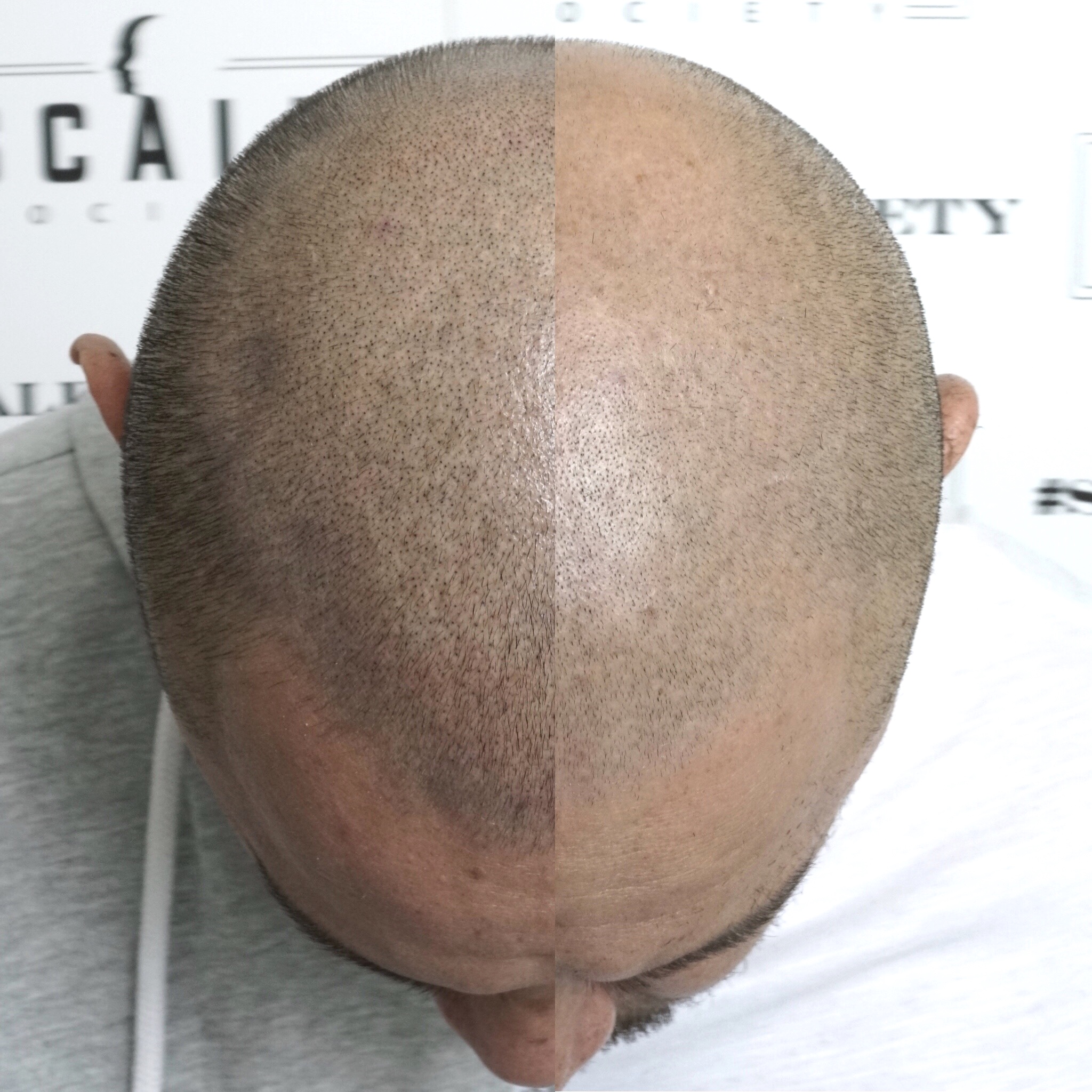 Male 30. This density was achieved after the first session! Micropigment is guaranteed to make difference. Unlike invasive hair transplants that are more expensive and not guaranteed to work. 