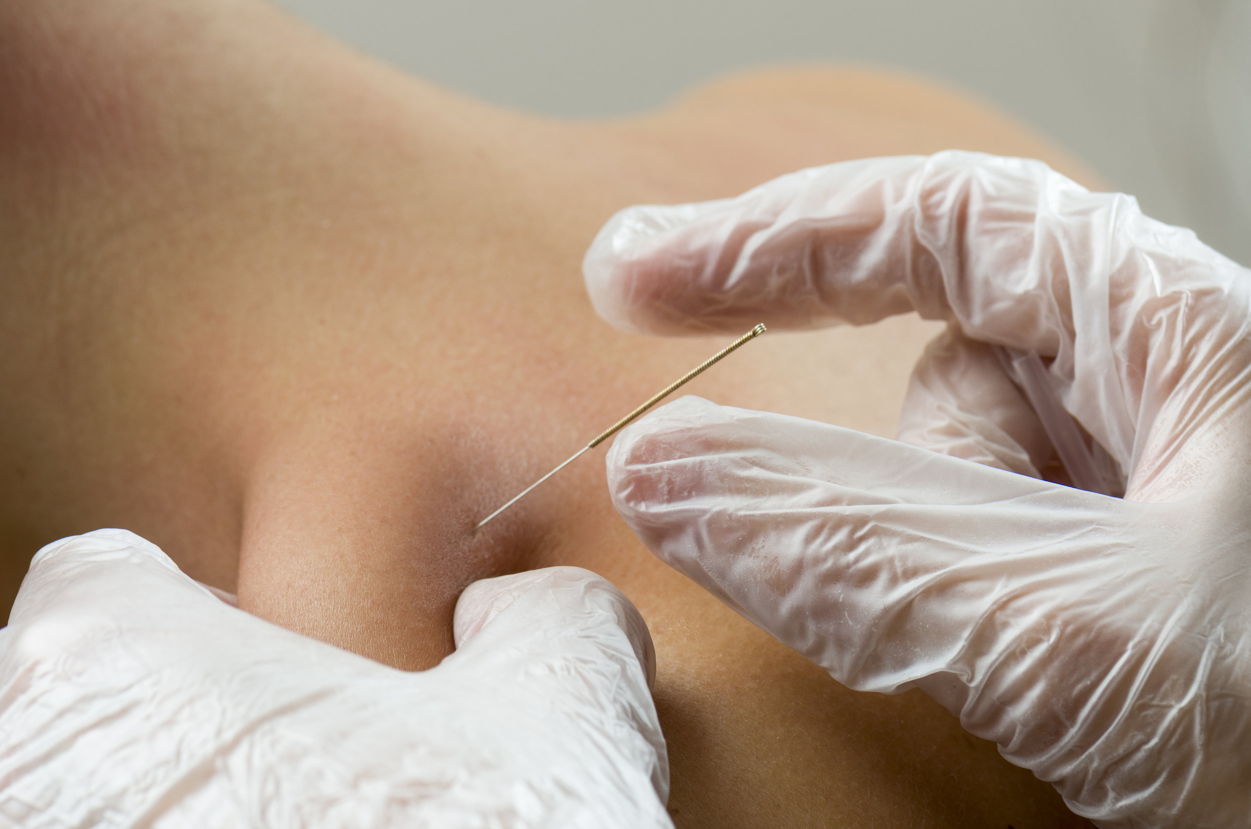 What is Dry Needling?