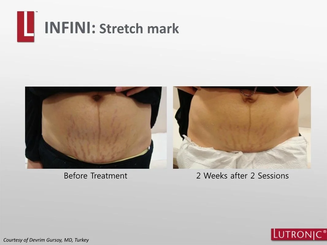 Stretch Marks Treated with Lutronic's INFINI