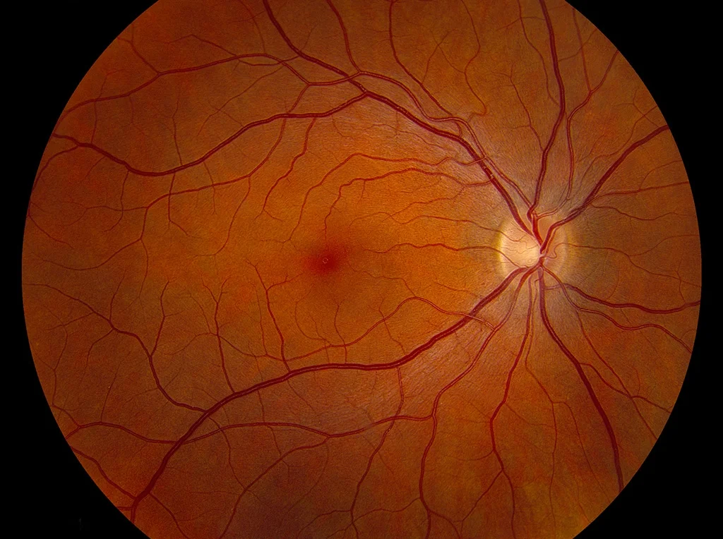 Normal-fundus-LRG.jpg