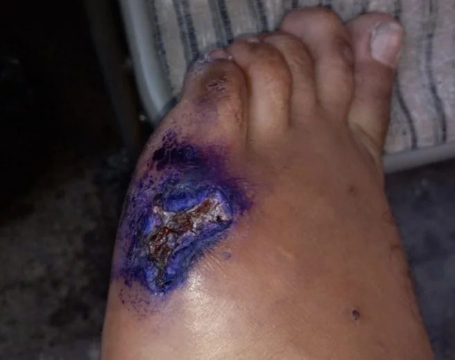 Safety Moment Monday! Concrete Burns