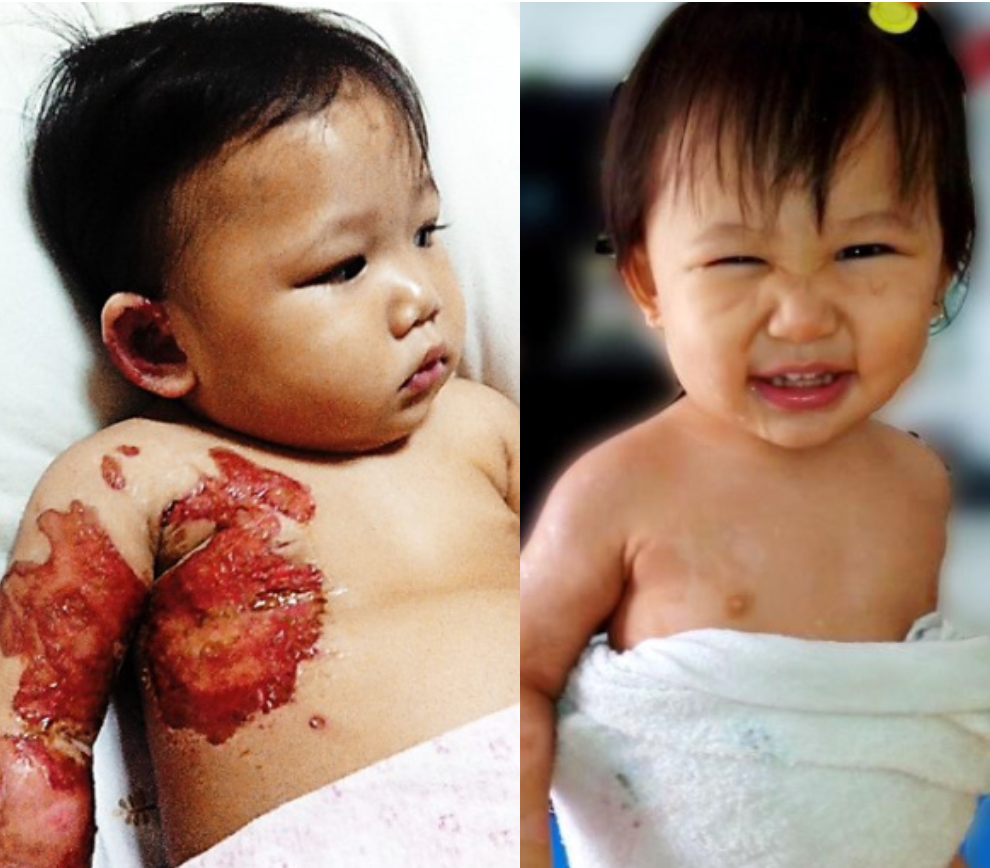 Faith's 2nd Degree Burns Were Healed in 10 Days