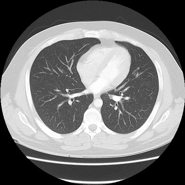CHEST CT 23.jpg