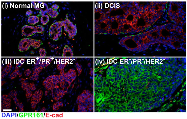 Expression of the orphan GPCR GPR161 (green) in the normal human mammary gland (i), a premalignant lesion (ii), and invasive breast cancer (iii,iv).