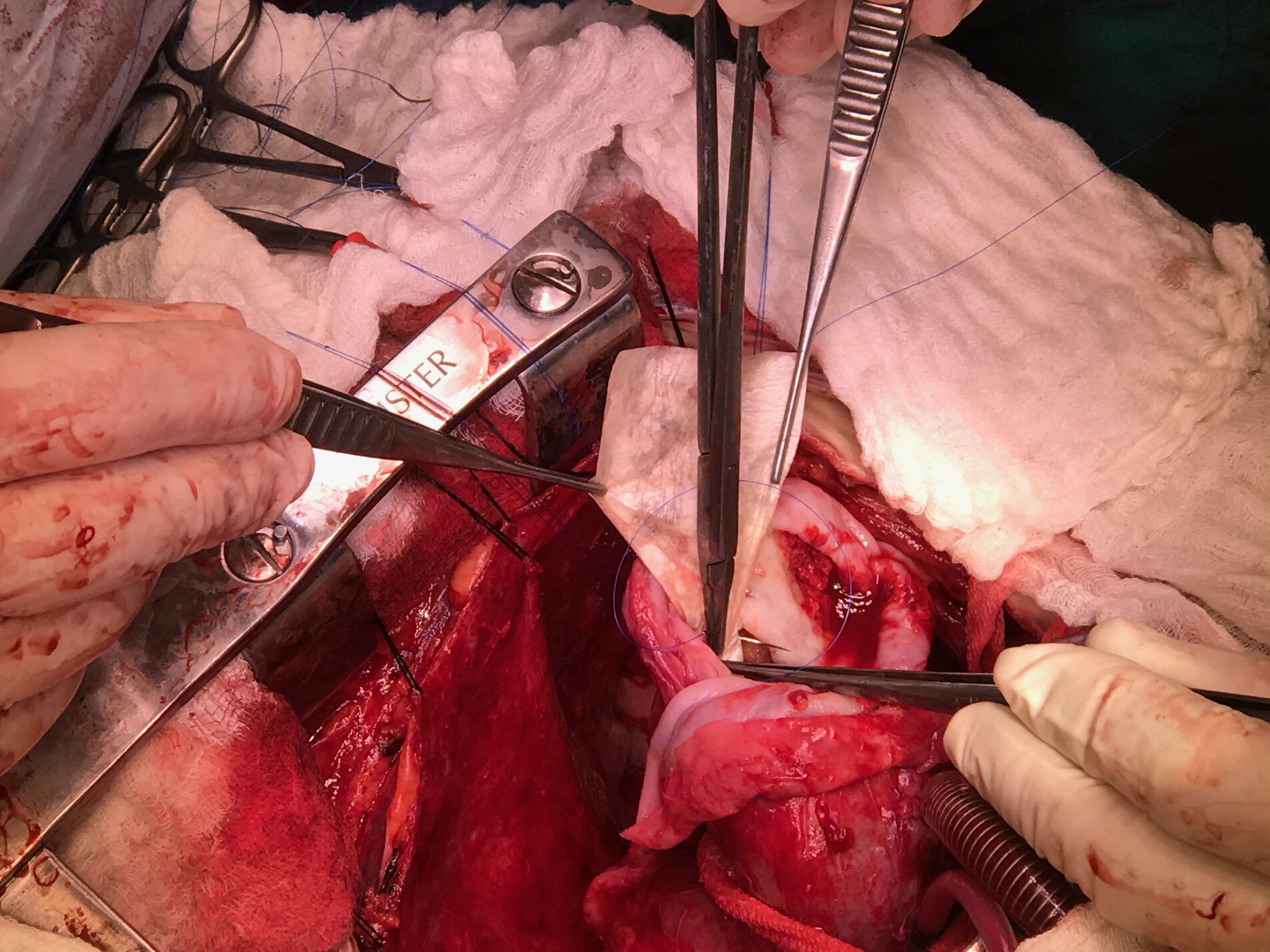 cormatrix pseudoaneurisma.JPG