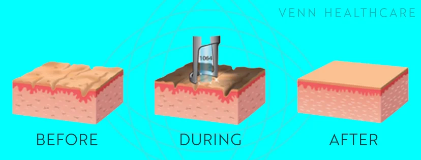 Vennhealthcare_Carbonpeel.jpg