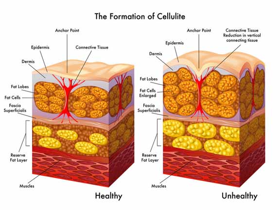 What+is+cellulite+and+how+is+it+formed_resized.jpg