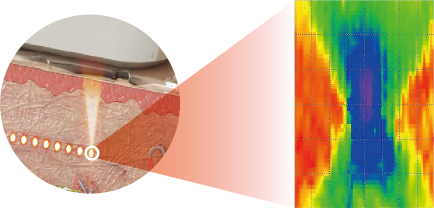 4MHz, 4.5mm focused ultrasound beam delivers controlled energy with precision to the focal region.