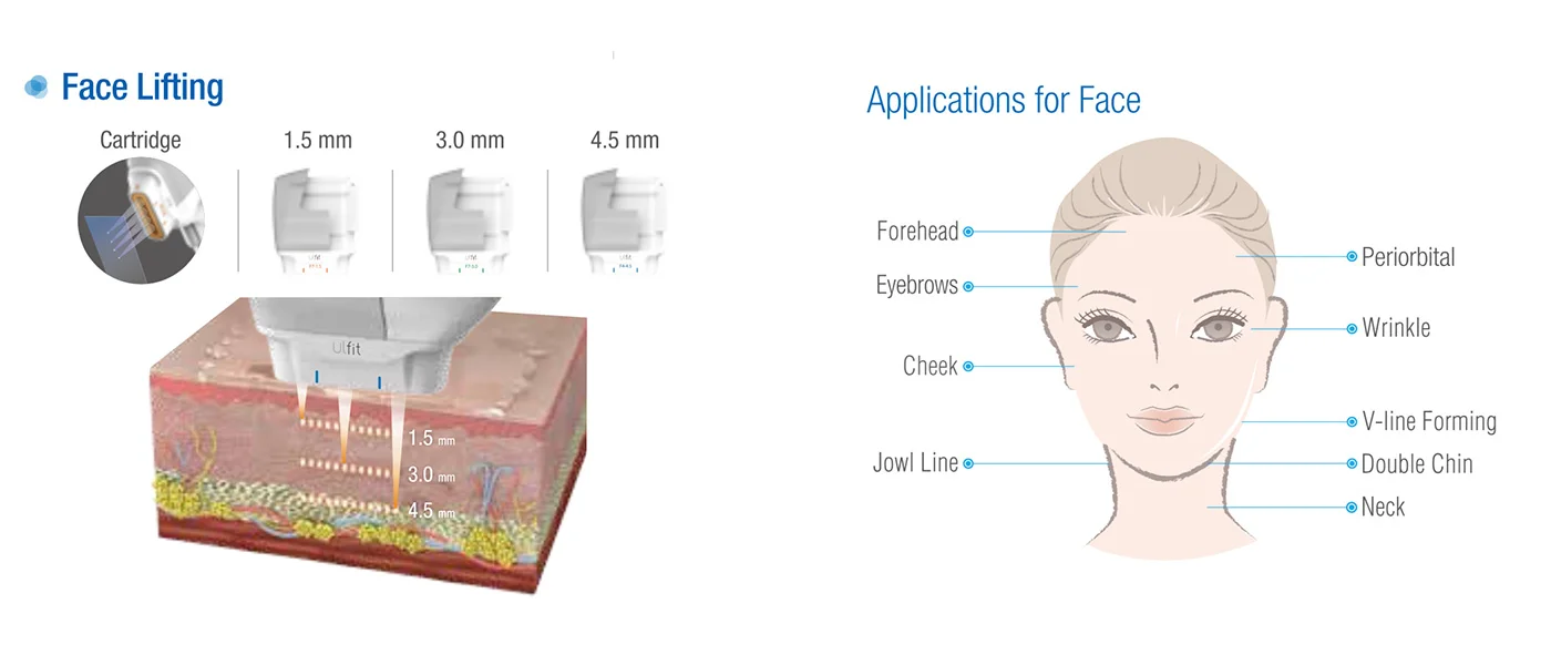 ULfit face-lifting HIFU.jpg