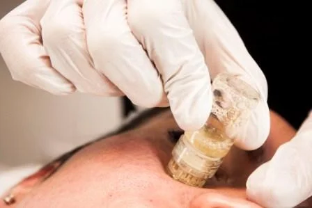 Aquagold Fine Touch micro botox fillers london.jpg