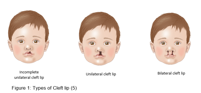 Types of cleft lip_0.png