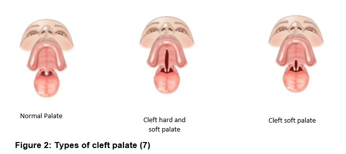 Types of cleft palate.png