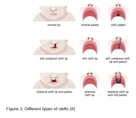 Different types of clefts.png