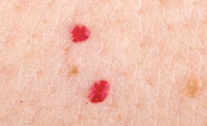 What are small red skin bumps from?