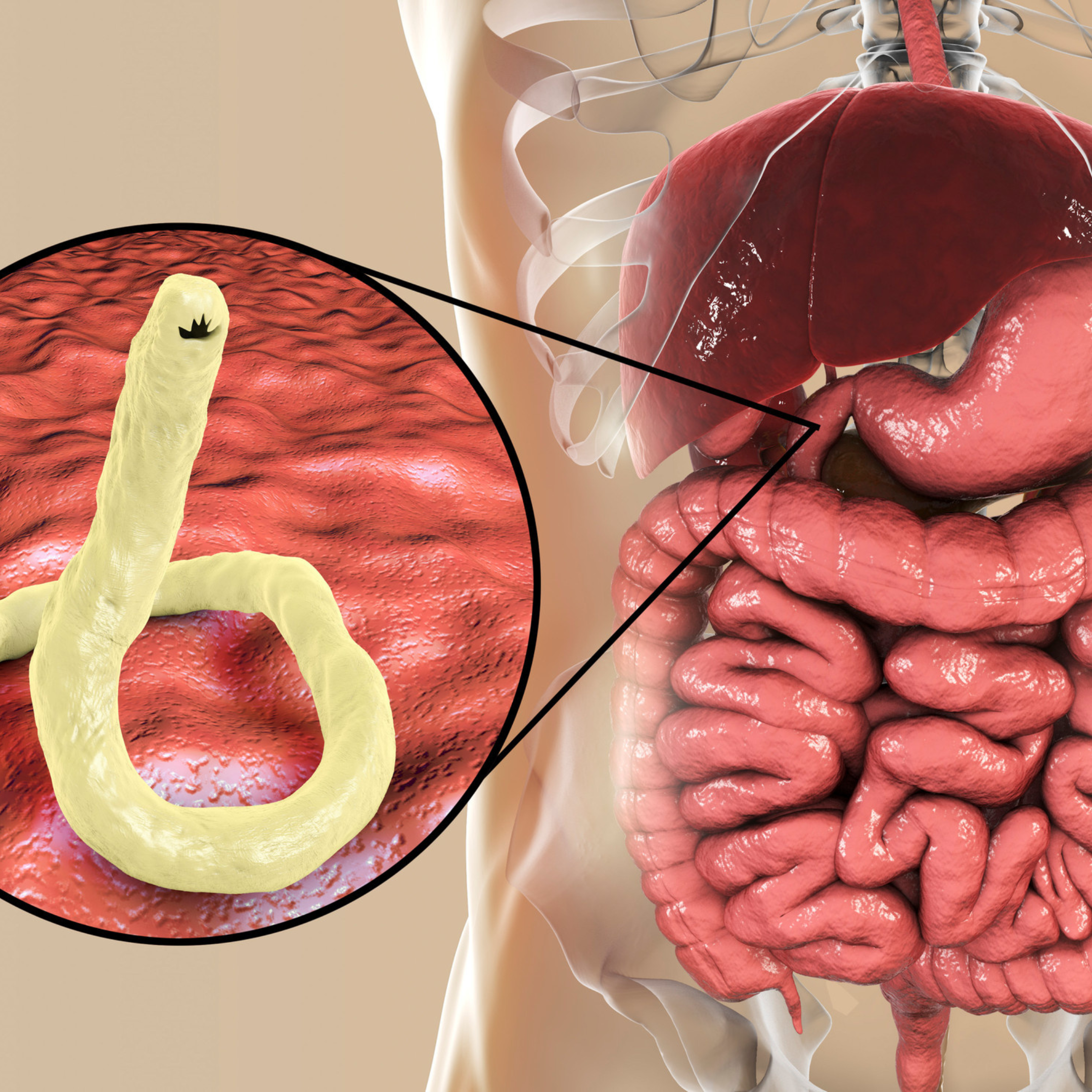 What You Should Know About Doing a Parasite Cleanse