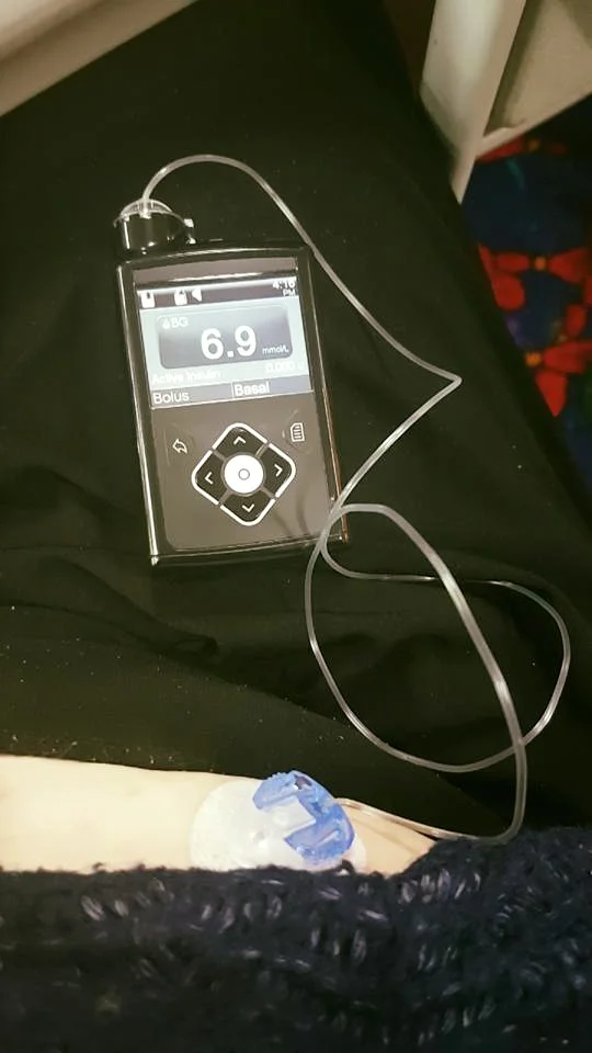 Medtronic 640g Insulin Pump