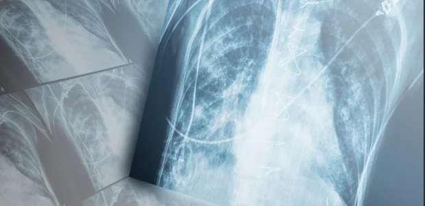 READ: NIOSH Standard: Occupational Exposure to Diacetyl and Pentanedione - Hazard Prevention