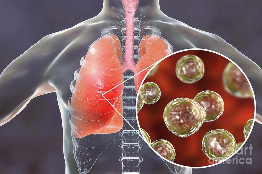 READ: Outbreak of Blastomycosis Among Paper Mill Workers