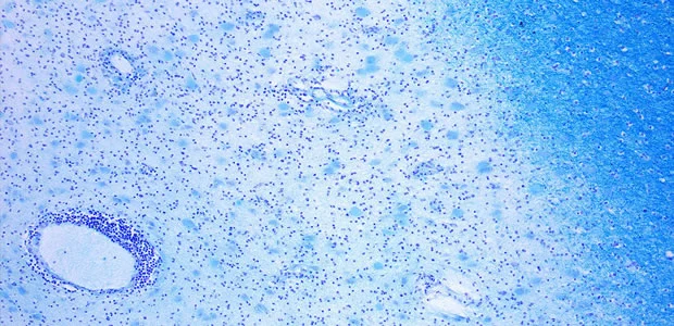 Cognitive Dysfunction and Grey Matter Lesions in MS