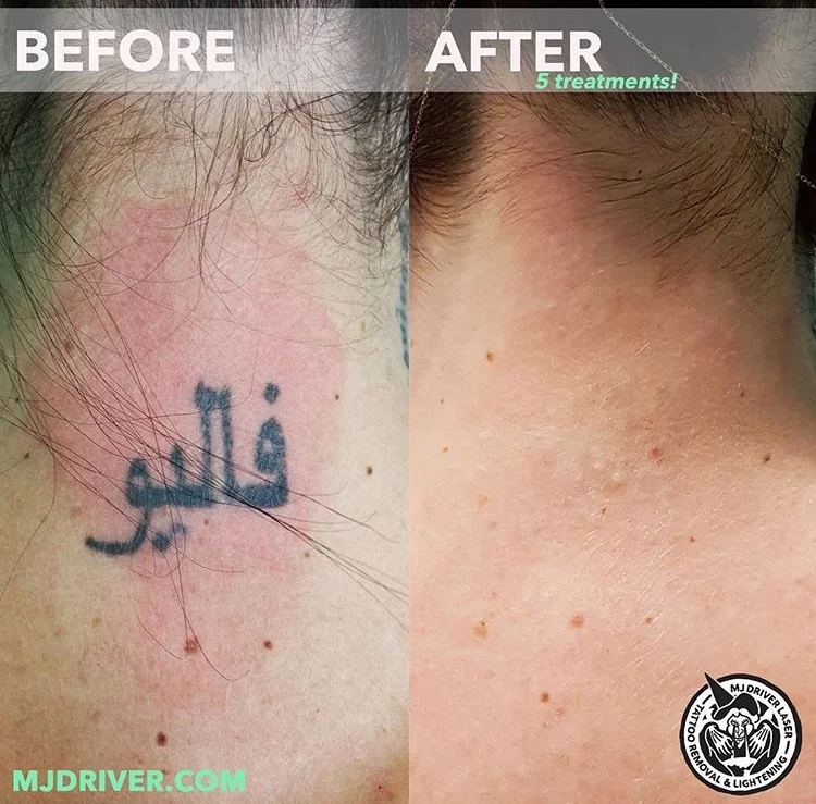 Before and After Laser Tattoo Removal — MJ Driver Laser